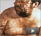 Monsters Inside Me: Flesh-Eating